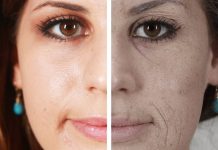 Smoking And Skin Health – 8 Reasons To Quit Traditional Tobacco Cigarette Smoking Smoking And Skin Health – 8